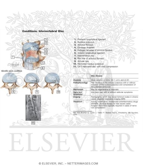 Watermarked preview of labeled image: Intervertebral Disc