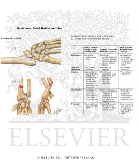 Monteggia Fracture
Galeazzi Fracture