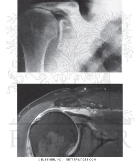 Conditions of the Rotator Cuff