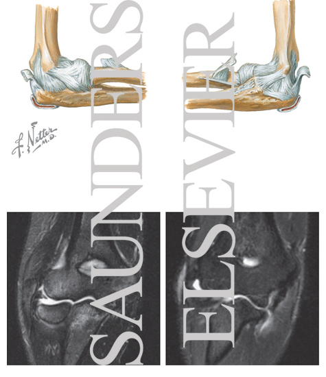 Watermarked preview of unlabeled image: Ligaments of the Elbow