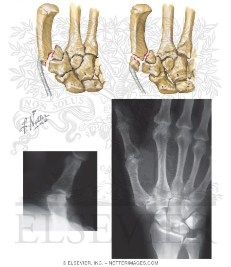 Bones of the Thumb