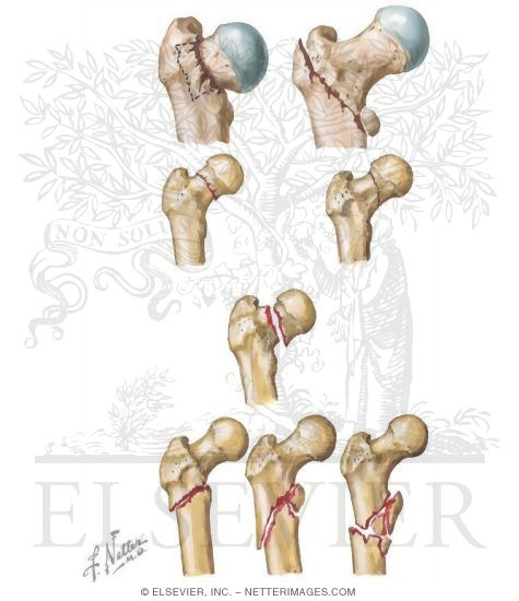 Proximal Femur