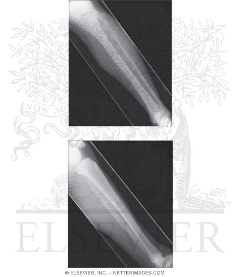 Watermarked preview of unlabeled image: Radiographic Anatomy of the Lower Leg
