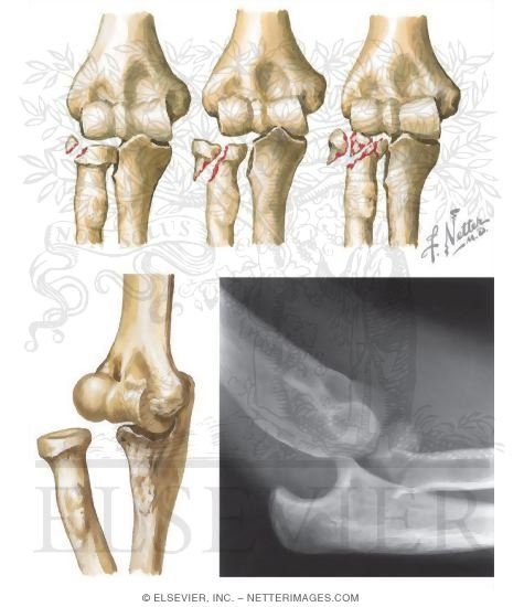 Radial Head of the Elbow