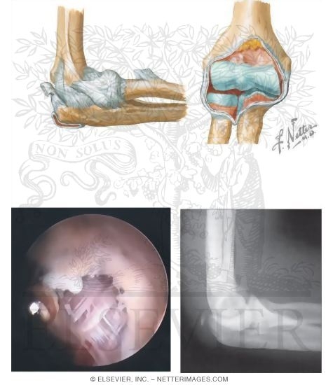 Tendons In the Elbow