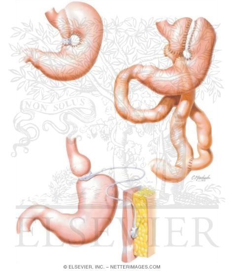 Watermarked preview of unlabeled image: Surgical Options In Obesity