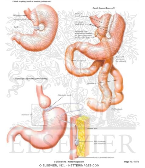 Watermarked preview of labeled image: Surgical Options In Obesity