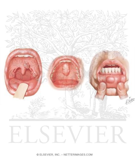 Watermarked preview of unlabeled image: Common Oral Lesions