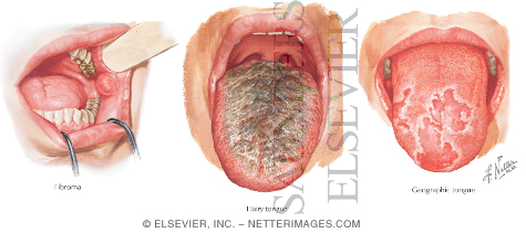 Watermarked preview of labeled image: Common Oral Lesions