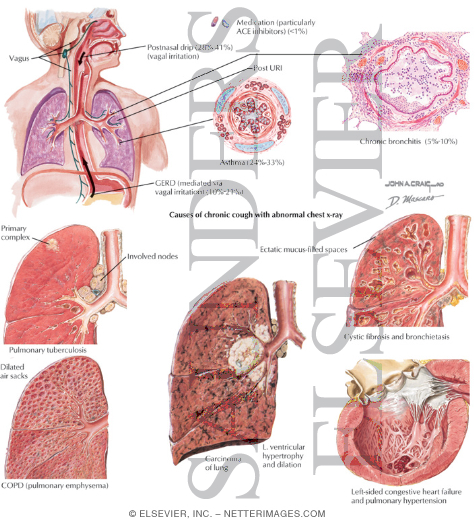 Watermarked preview of labeled image: Causes of Chronic Cough