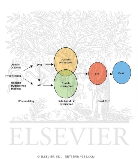 Watermarked preview of labeled image: Development of Congestive Heart Failure In Patients With Hypertension