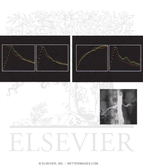 Watermarked preview of unlabeled image: Captopril Renogram