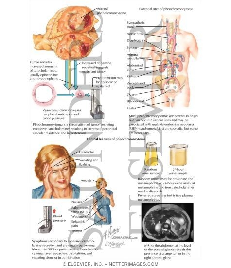 Pheochromocytoma
