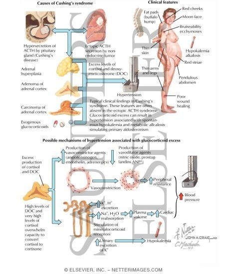 Cushing's Syndrome and Mineralocorticoid Hypertension