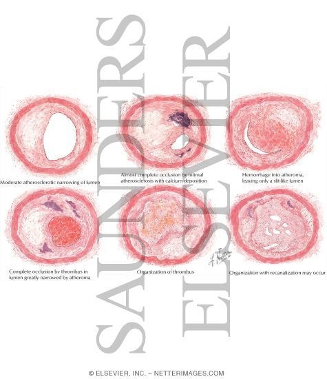 Watermarked preview of labeled image: Pathologic Changes In Coronary Artery Disease
Types and Degrees of Coronary Atherosclerotic Narrowing Or Occlusion
