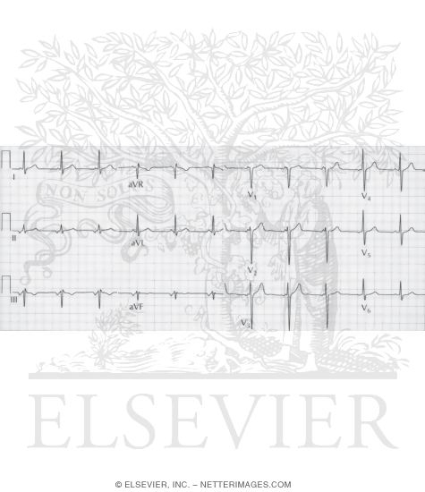 Watermarked preview of unlabeled image: Ectopic Atrial Rhythm