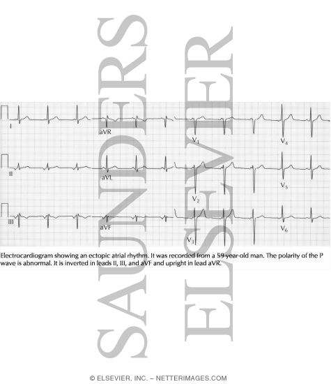 Watermarked preview of labeled image: Ectopic Atrial Rhythm