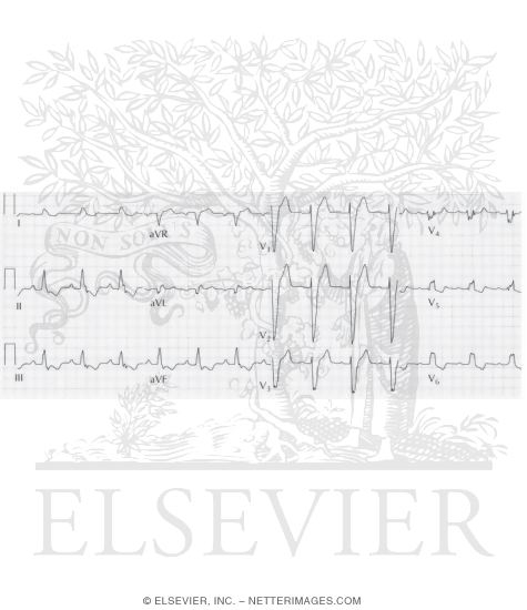 Watermarked preview of unlabeled image: Bundle Branch Block
