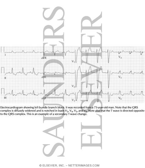Watermarked preview of labeled image: Bundle Branch Block