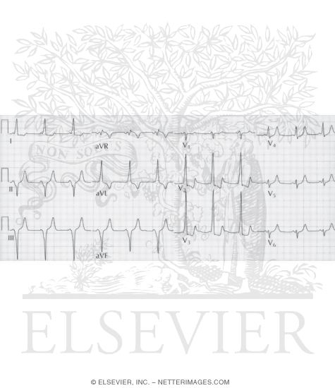 Watermarked preview of unlabeled image: Ventricular Preexcitation