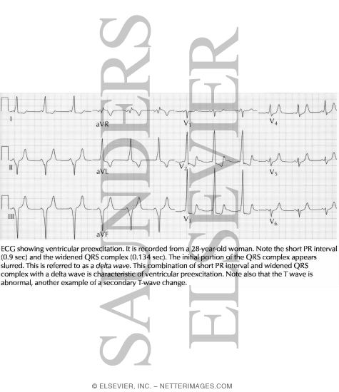 Watermarked preview of labeled image: Ventricular Preexcitation
