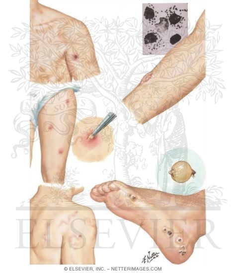 Watermarked preview of unlabeled image: Common Skin Disorders of Travelers
