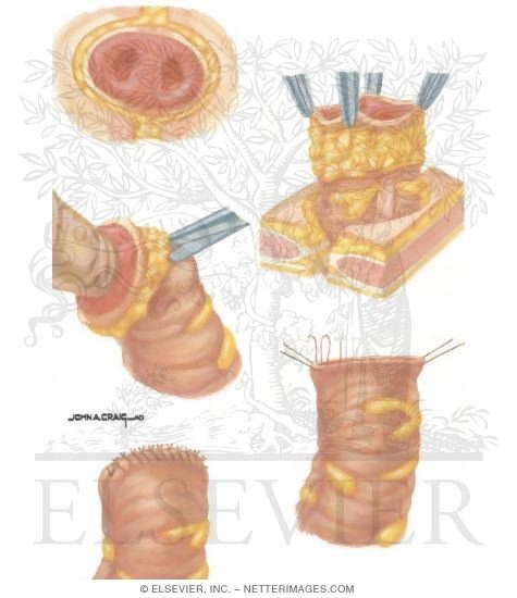 Types of Stomas: Colostomy Closures