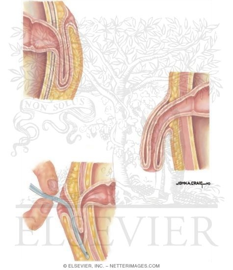 Watermarked preview of unlabeled image: Types of Stomas: Complications