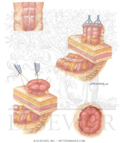 Types of Stomas: End Colostomy