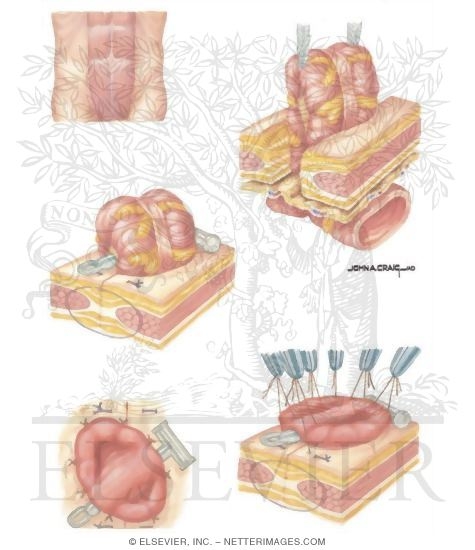 Types of Stomas: Transverse Colostomy