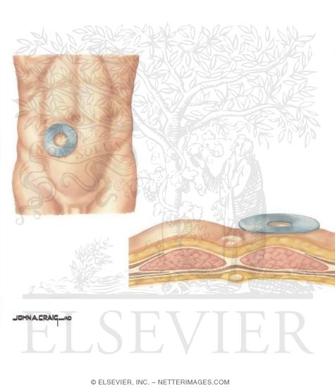 Watermarked preview of unlabeled image: Types of Stomas: Location for Ileostomy Incision