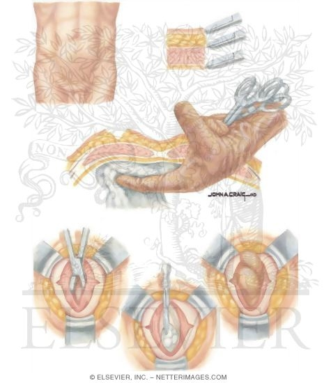 Watermarked preview of unlabeled image: Types of Stomas: Ileostomy Incision Technique