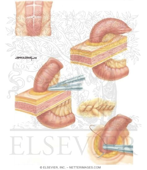 Watermarked preview of unlabeled image: Types of Stomas: Brooke Ileostomy Technique