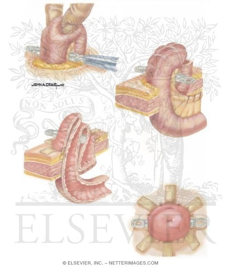 Types of Stomas: Loop and Ileostomy Technique