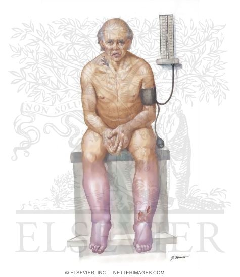 Watermarked preview of unlabeled image: 61-year-old Man With Previous Bypass Surgery