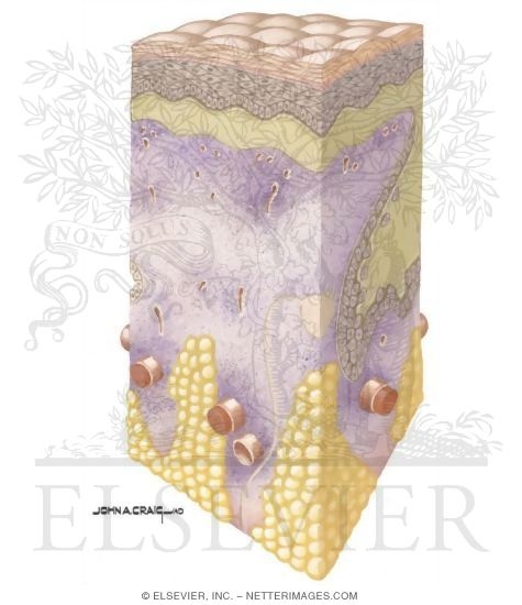 Watermarked preview of unlabeled image: Conversion of Partial Thickness Injury to Full Thickness Injury By Infection