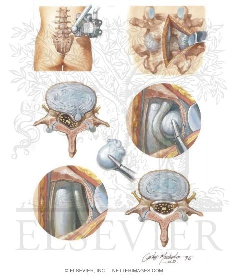 Watermarked preview of unlabeled image: Microdiscectomy