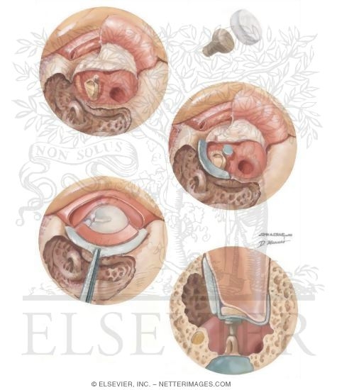 Watermarked preview of unlabeled image: Removal of Cholesteatoma With Reconstruction