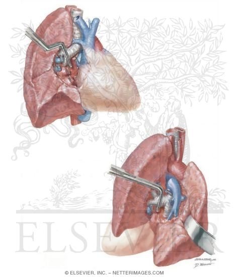 Pneumonectomy and Lobectomy