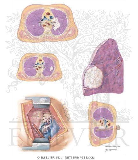 Watermarked preview of unlabeled image: Radiation Therapy of the Lung
