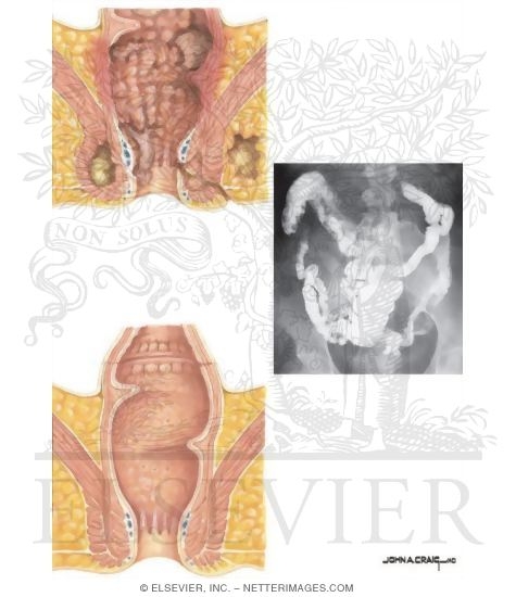 Watermarked preview of unlabeled image: Types of Stomas: Some Indication for an Ileostomy