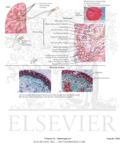 Watermarked preview of labeled image: Pathology of Status Asthmaticus
Pathology of Asthma