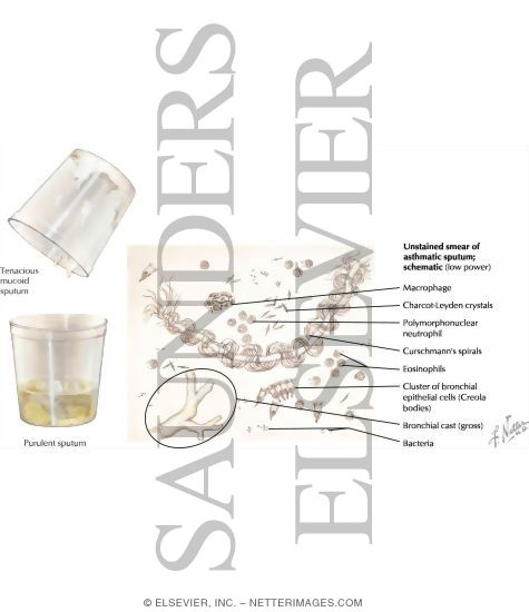 Watermarked preview of labeled image: The Sputum in Bronchial Asthma