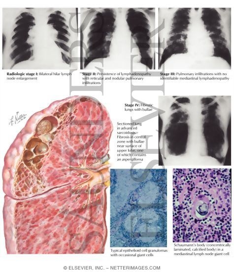 Watermarked preview of labeled image: Sarcoidosis