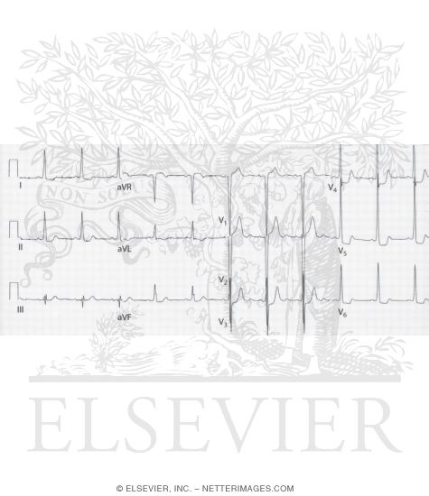 Watermarked preview of unlabeled image: ECG Changes of LV Hypertrophy
