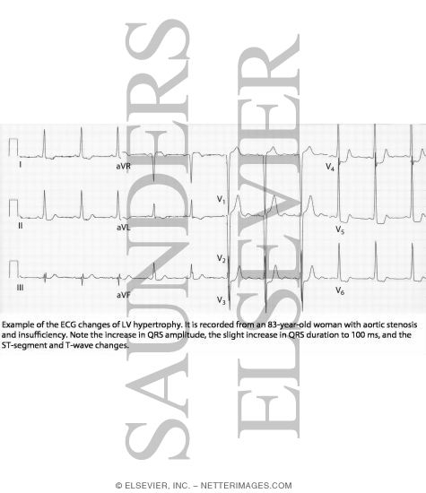 Watermarked preview of labeled image: ECG Changes of LV Hypertrophy