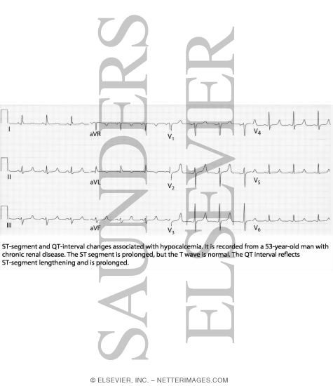 Watermarked preview of labeled image: ST-Segment and QT-Interval Changes Associated With Hypocalcemia