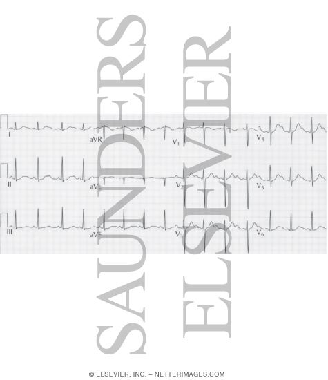 Watermarked preview of unlabeled image: Congenital Long QT Syndrome