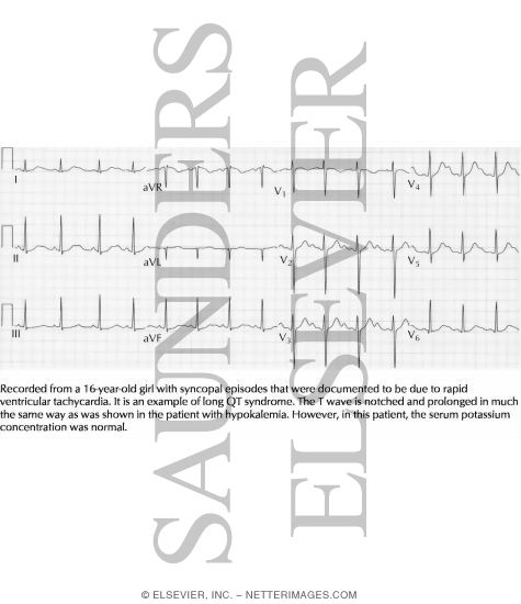 Watermarked preview of labeled image: Congenital Long QT Syndrome