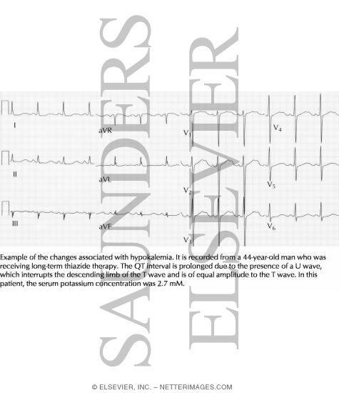 Watermarked preview of labeled image: Changes Associated With Hypokalemia
